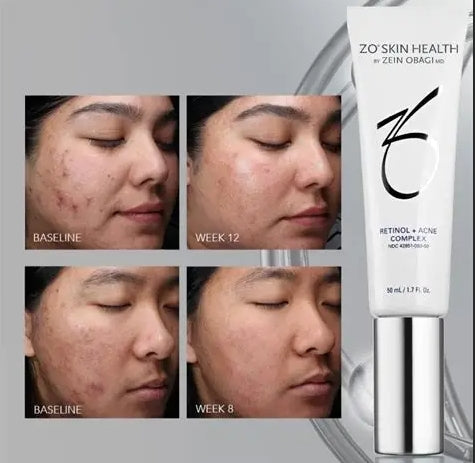 Zo Skin Health RETINOL + ACNE COMPLEX